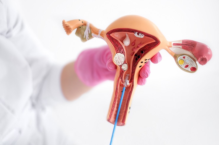 Электроэксцизия новообразования шейки матки