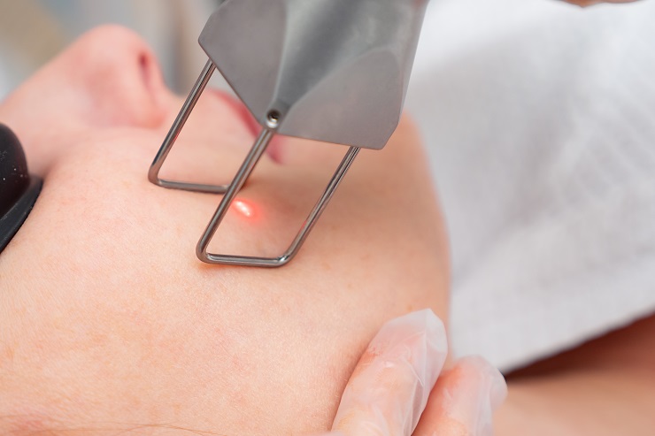 Лазерное удаление единичных кондилом, папиллом